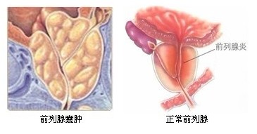 前列腺囊肿可并发感染及结石,较大的囊肿当其生长压向尿道或膀胱